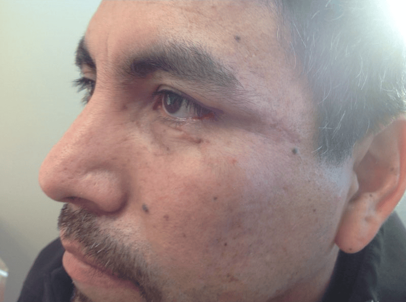 After Basal Cell Carcinoma Excision
