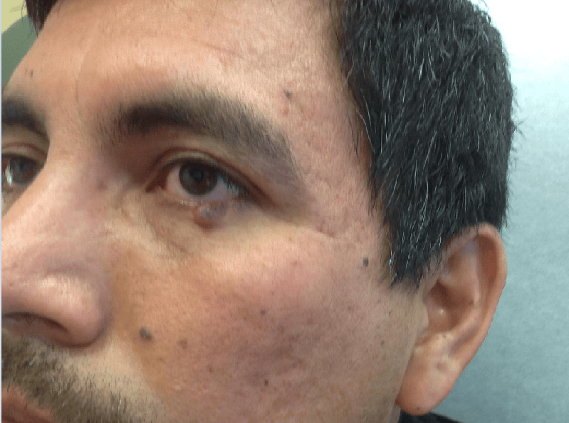 Before Basal Cell Carcinoma Excision