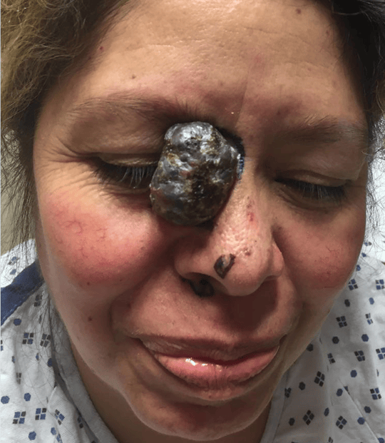 Before Basal Cell Carcinoma