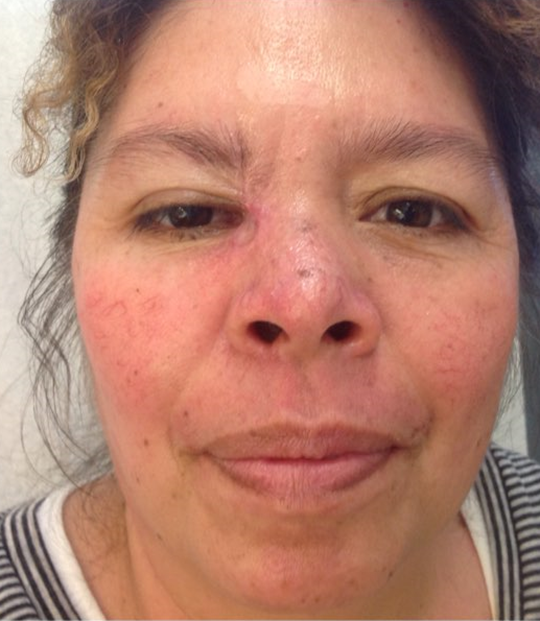 After Basal Cell Carcinoma