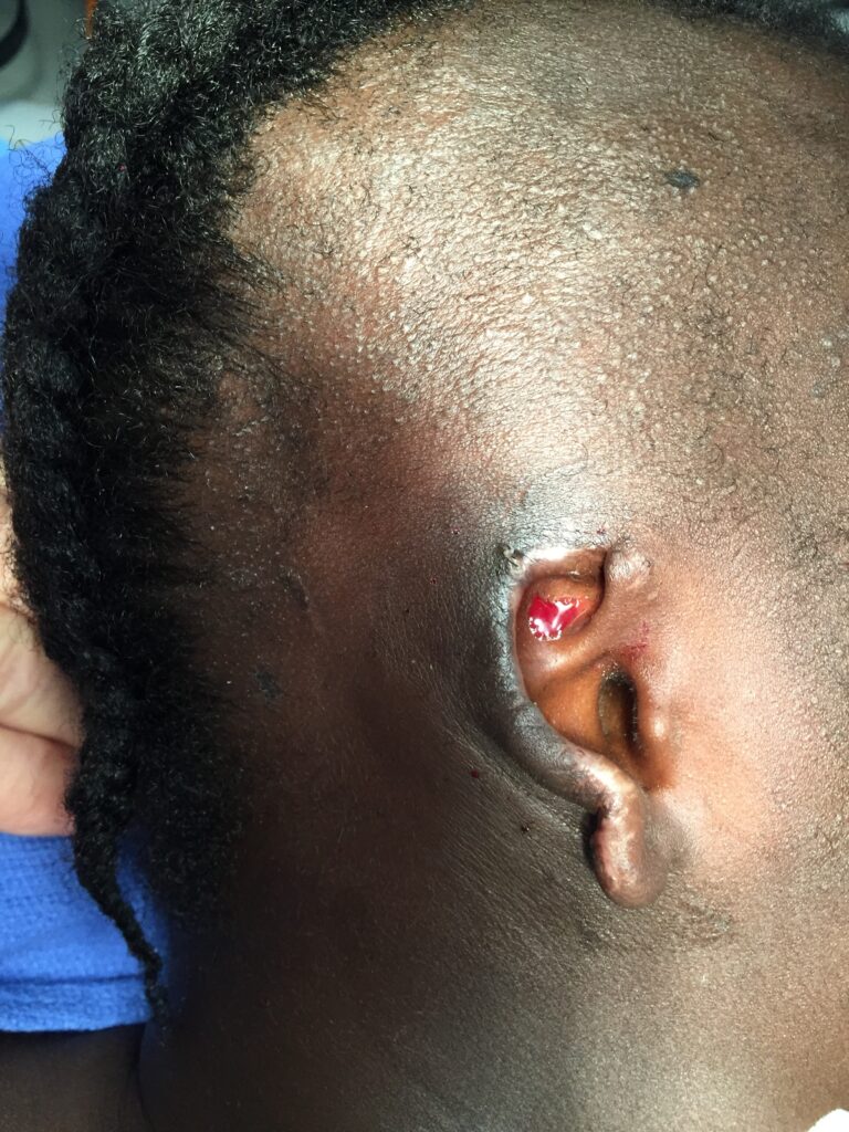 Haiti Humanitarian work ear surgery