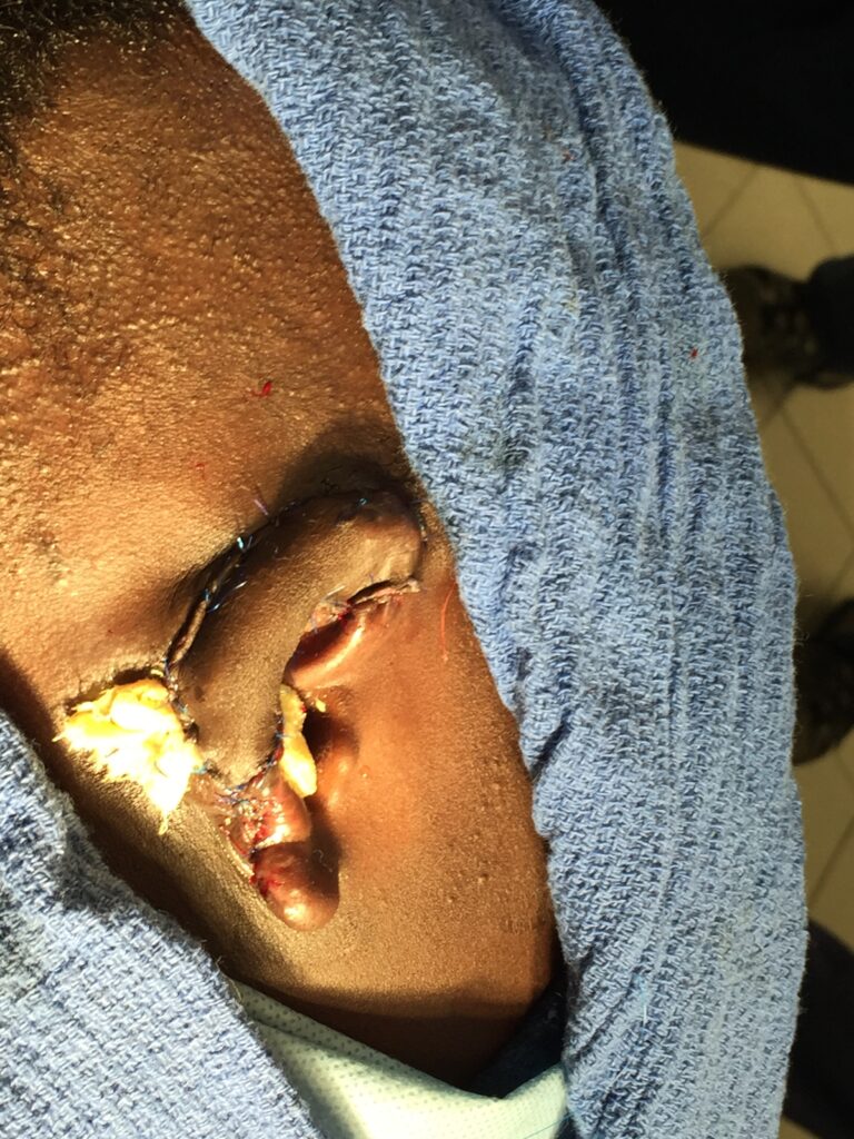 Haiti Humanitarian work post ear surgery