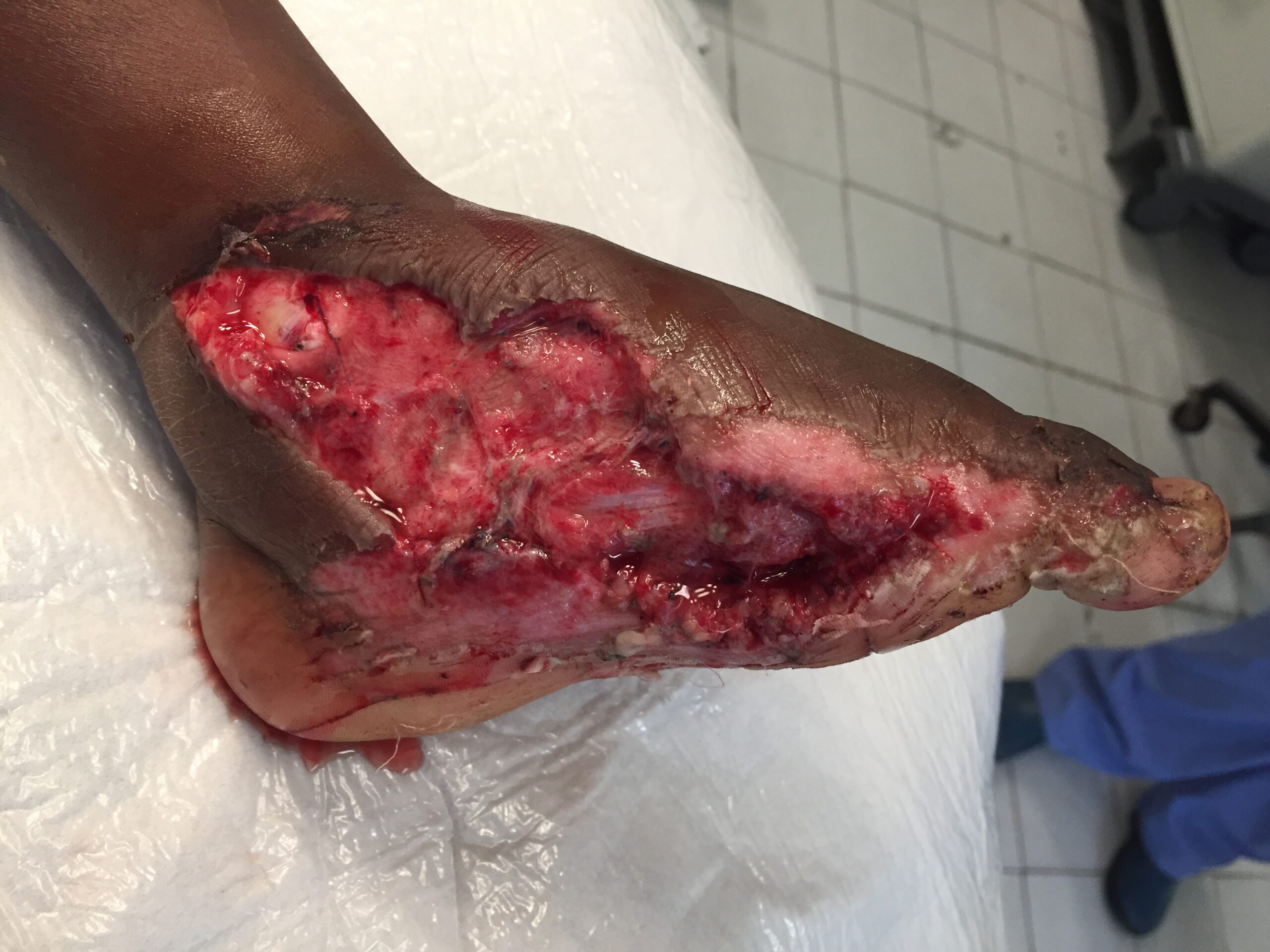 Pre Skin Graft from Hip 