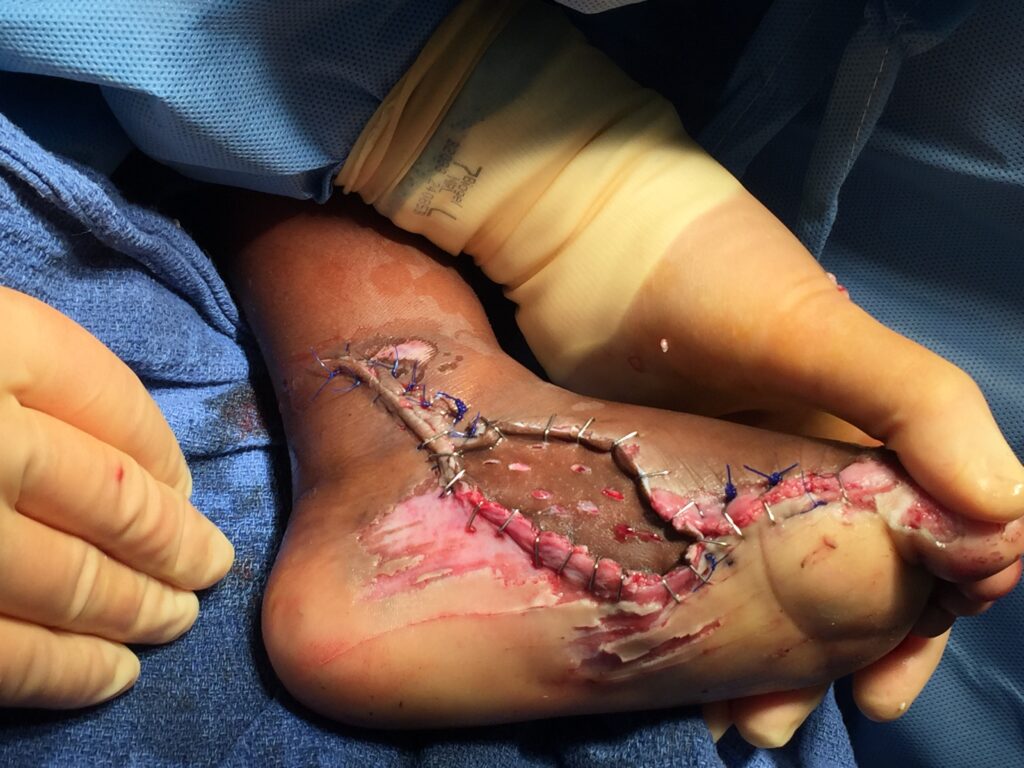 Post Skin Graft from Hip