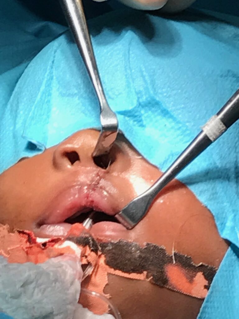 After cleft palate surgery