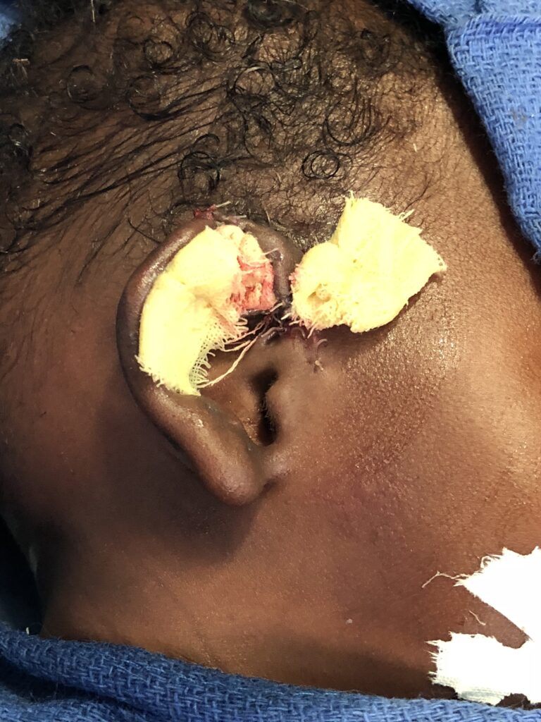 congenital ear deformity after surgery
