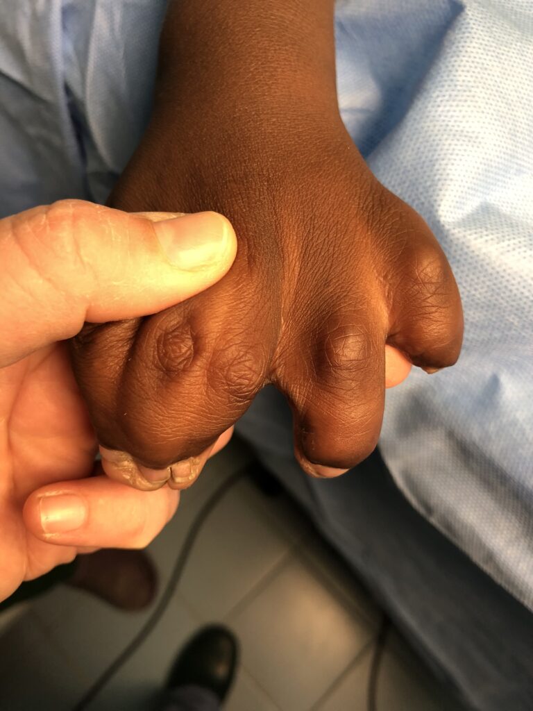 polysyndactyly pre