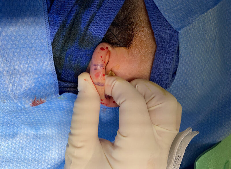 Before and After Melanoma Skin Cancer Washington DC