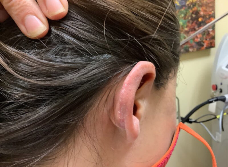 Before and After Melanoma Skin Cancer Washington DC