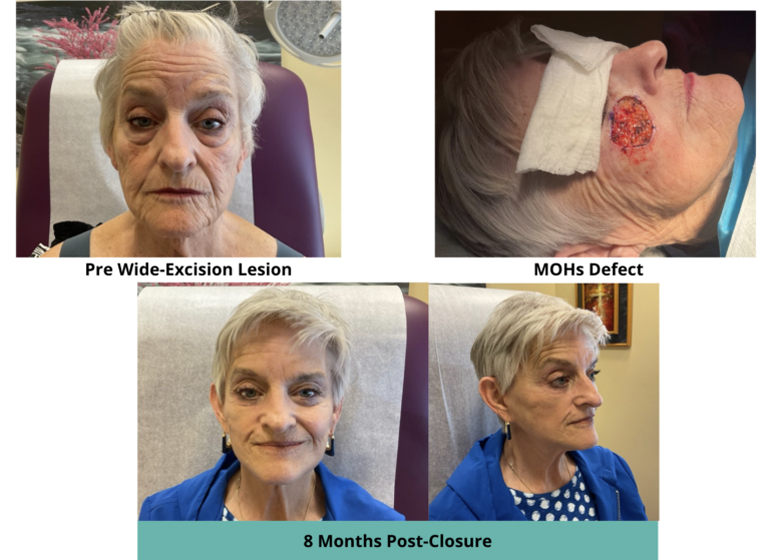 Before and After Melanoma Skin Cancer Washington DC