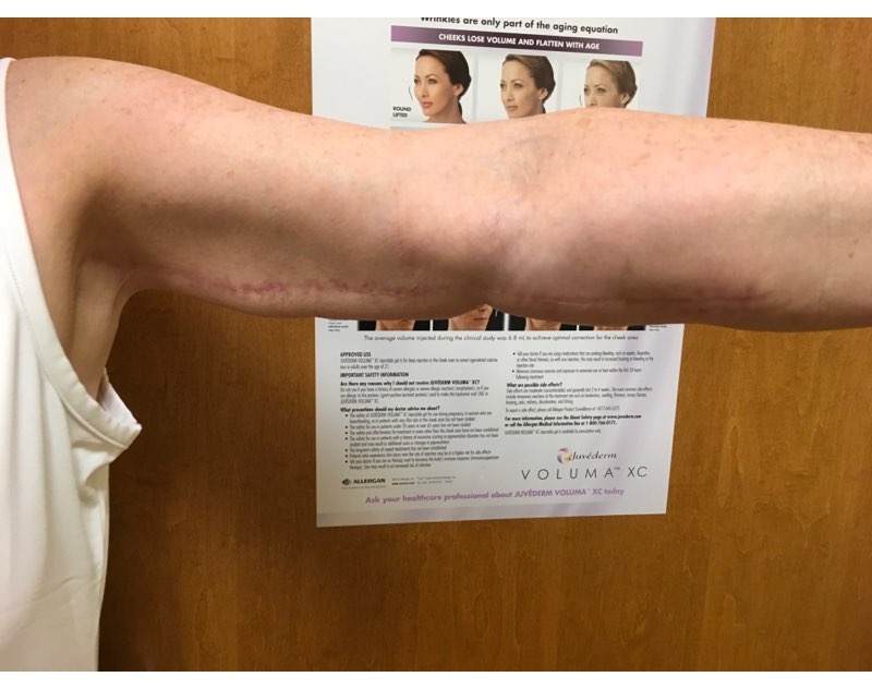 Before and After Arm Lift, Brachioplasty Washington, DC, Dr. Carter 1b