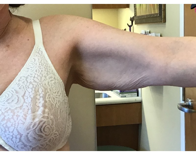 Before and After Arm Lift, Brachioplasty Washington, DC, Dr. Carter 1a