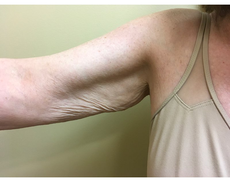 Before and After Arm Lift, Brachioplasty Washington, DC, Dr. Carter 2b
