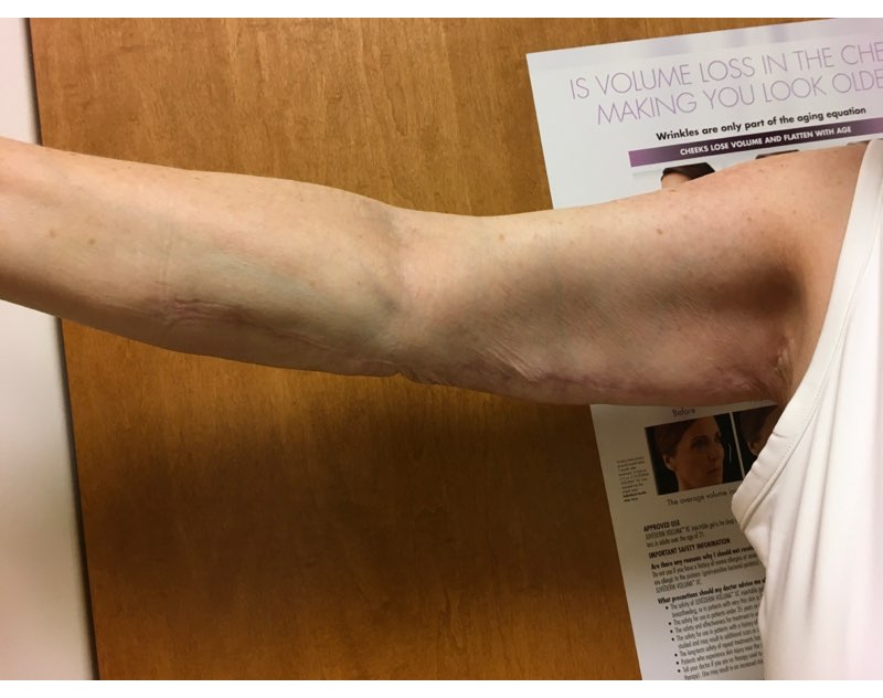 Before and After Arm Lift, Brachioplasty Washington, DC, Dr. Carter 2a