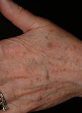 Before VBeam treatment