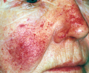 Before and After VBeam