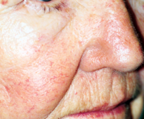 Before and After VBeam