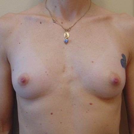 before and after breast augmentation - washington dc 1