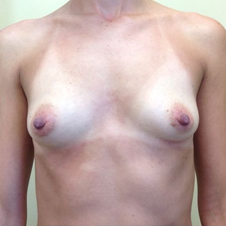 before and after breast augmentation - washington dc 7