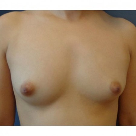 before and after breast augmentation - washington dc 11