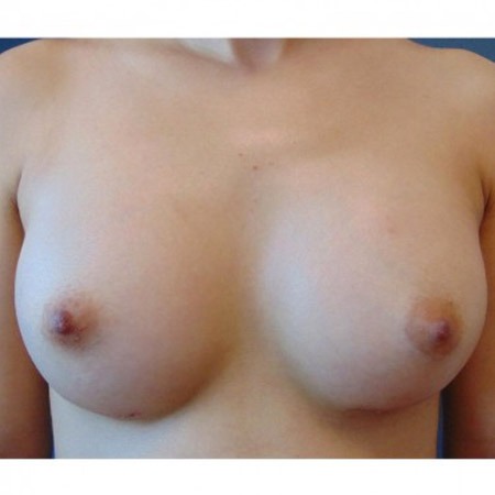 before and after breast augmentation - washington dc 12