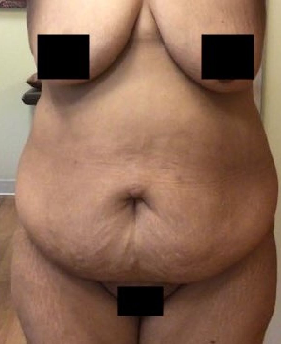 Before and After Body Lift - Washington DC 2a