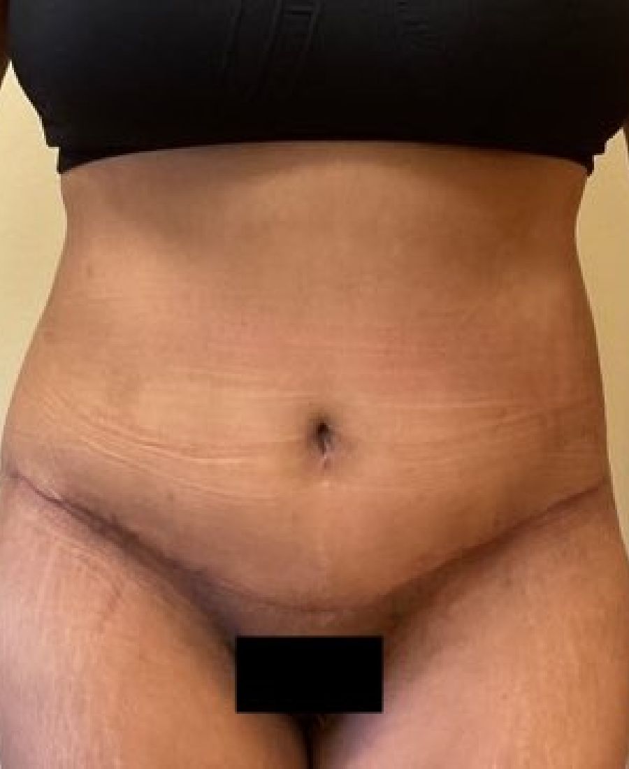 Before and After Body Lift - Washington DC 2b