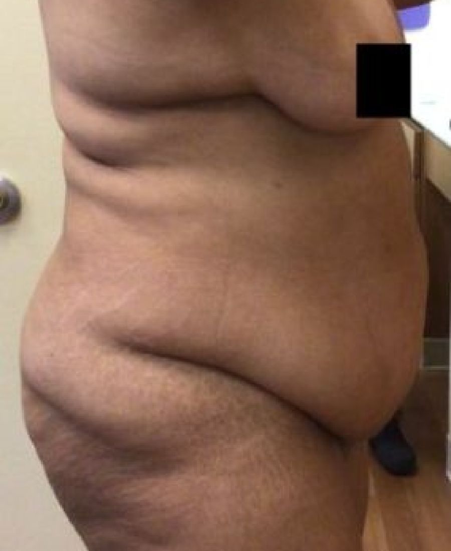 Before and After Body Lift - Washington DC 2c