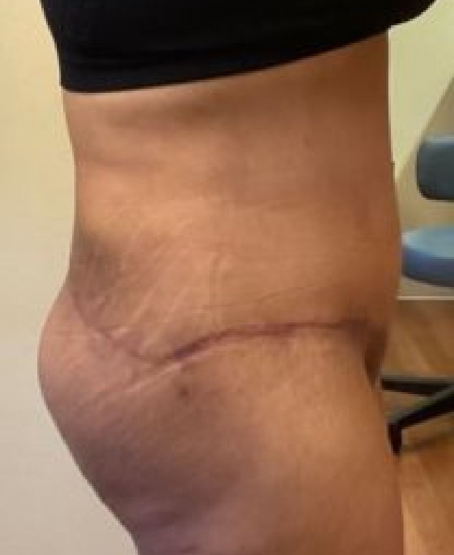 Before and After Body Lift - Washington DC 2d