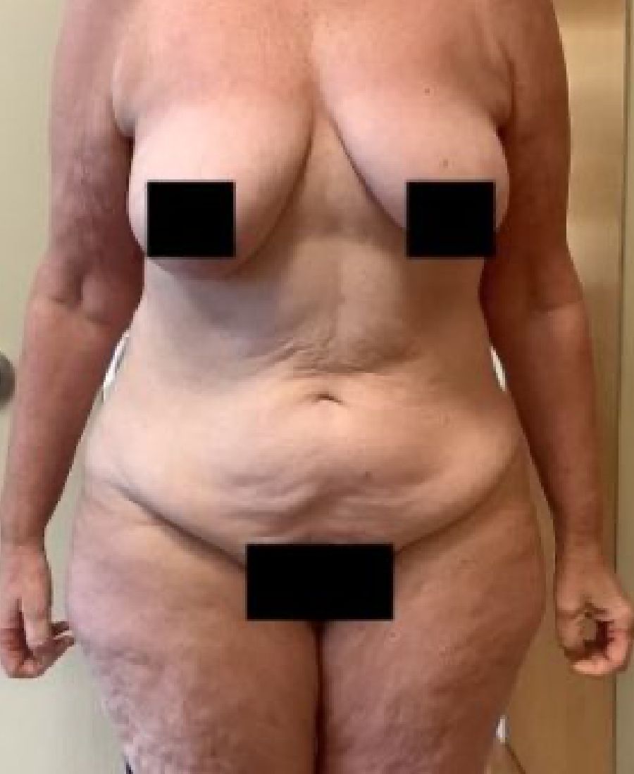 Before and After Body Lift - Washington DC 3a