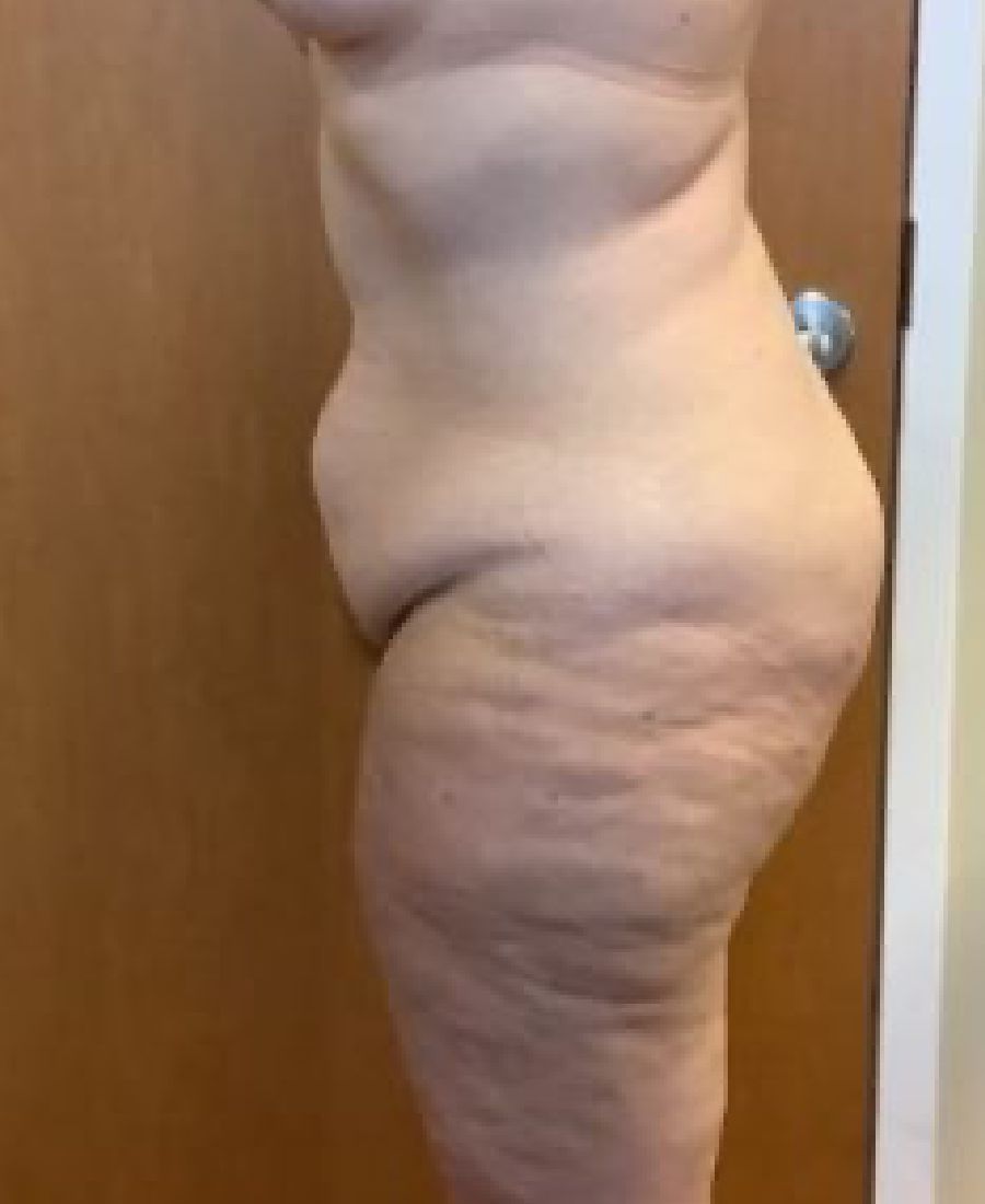 Before and After Body Lift - Washington DC 3c