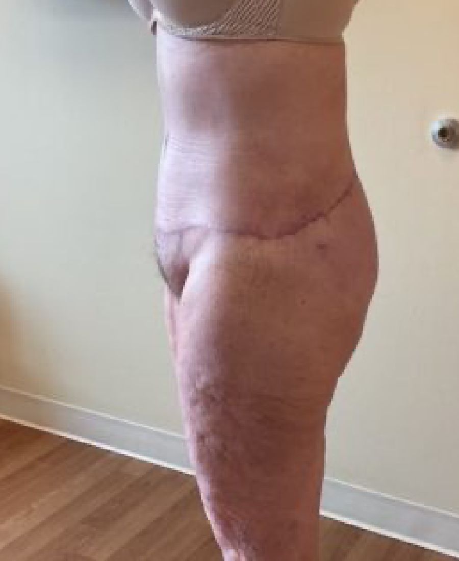 Before and After Body Lift - Washington DC 3d