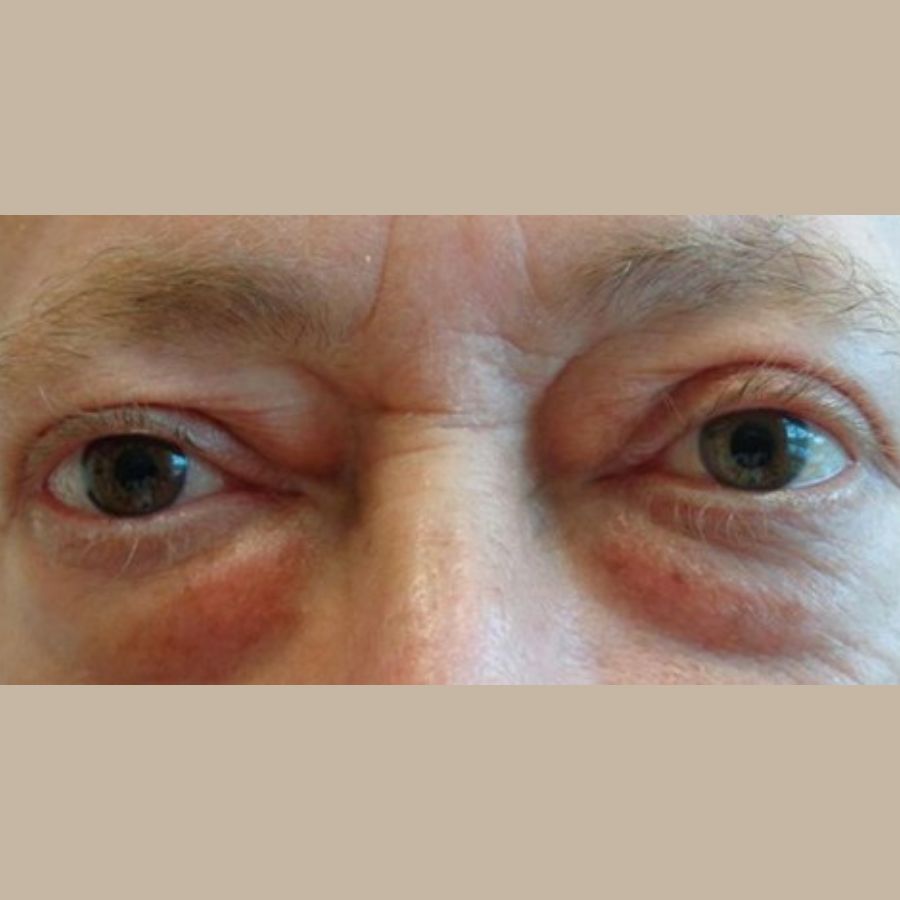 Before and After Eyelid Surgery - Washington DC 1a