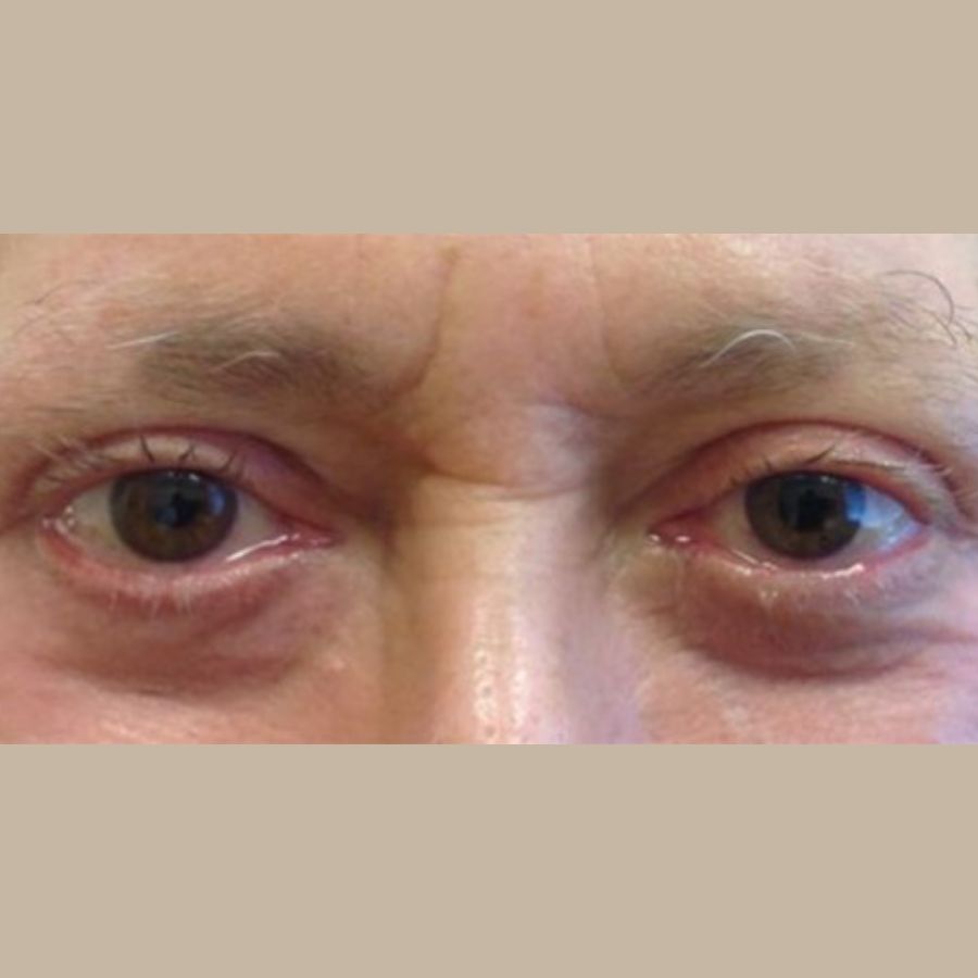 Before and After Eyelid Surgery - Washington DC 1b