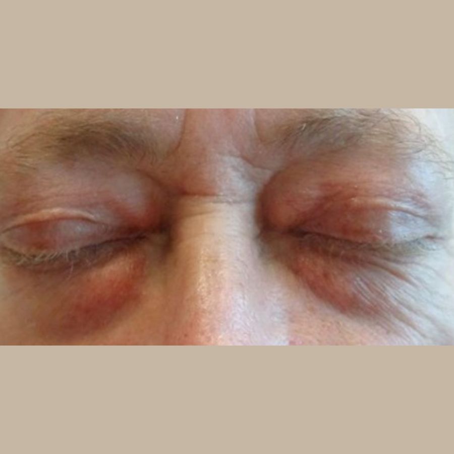 Before and After Eyelid Surgery - Washington DC 1c