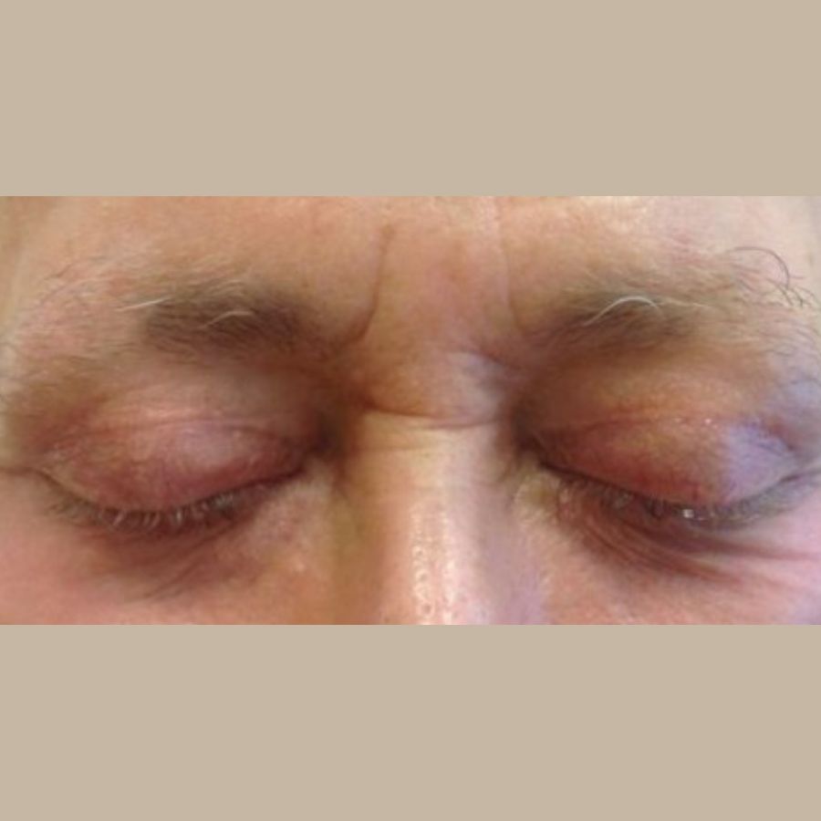 Before and After Eyelid Surgery - Washington DC 1d