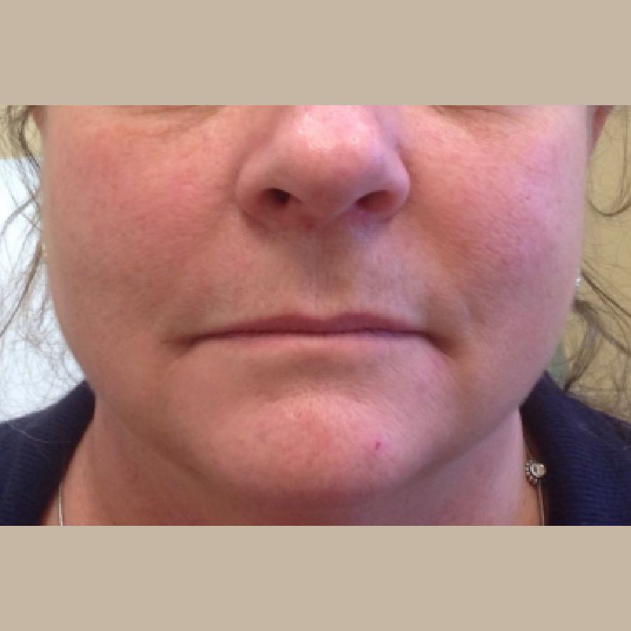 Before and After Injectables - Washington DC 1a