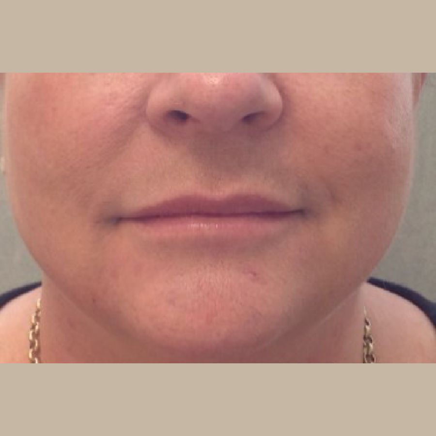 Before and After Injectables - Washington DC 1b