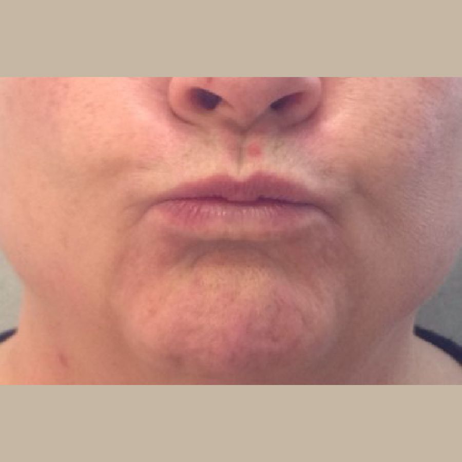 Before and After Injectables - Washington DC 1c