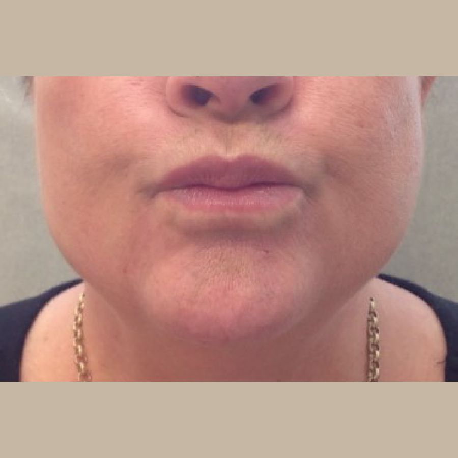 Before and After Injectables - Washington DC 1d