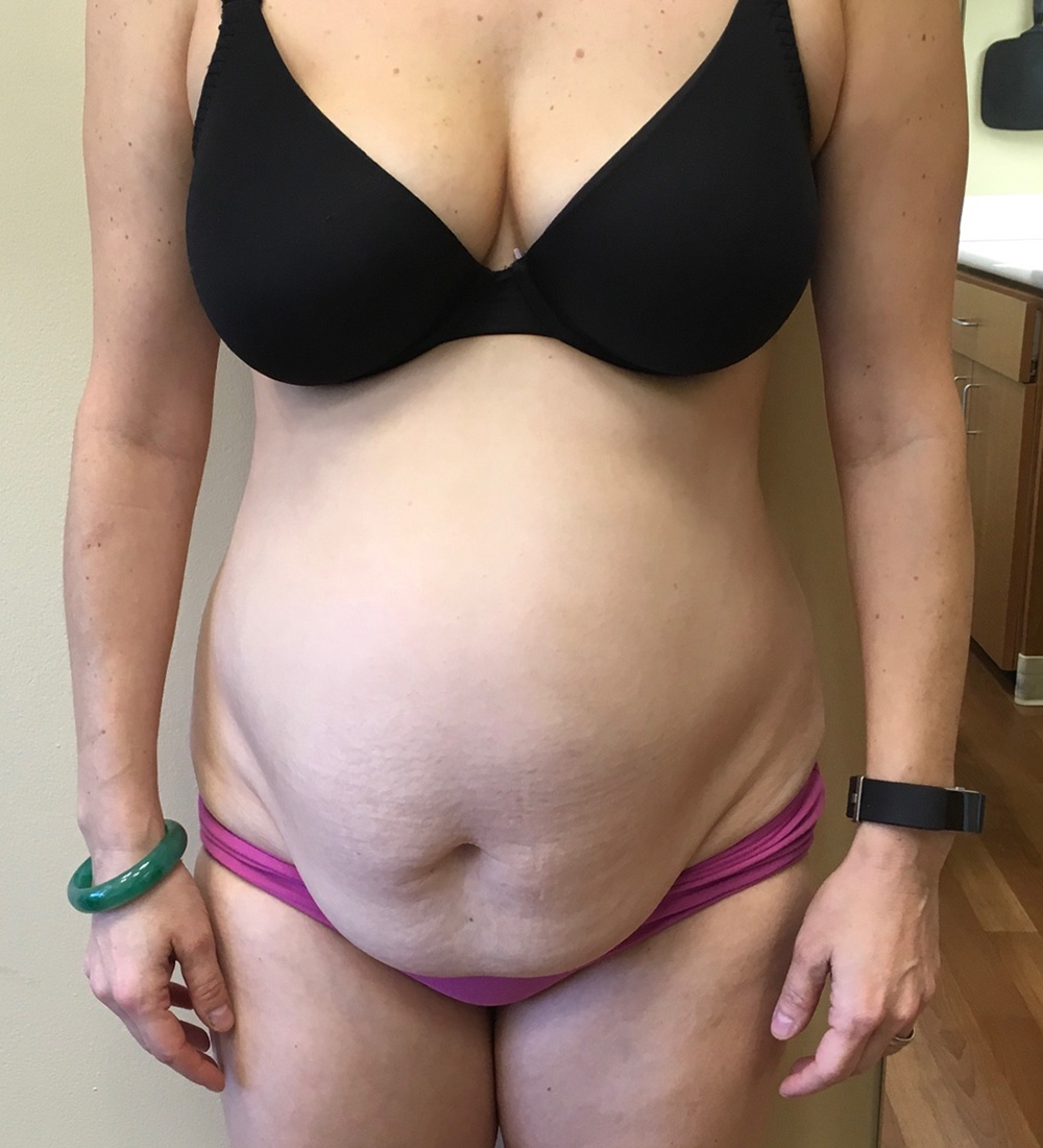 Before and After Tummy Tuck - Washington DC 3