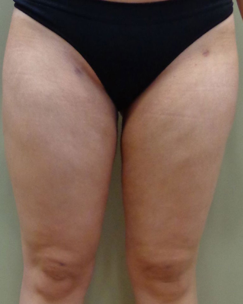 Before and After Liposuction - Washington DC 2