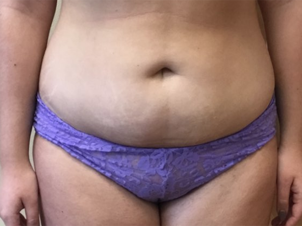 Before and After Liposuction - Washington DC 3