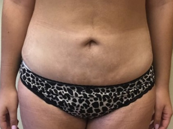 Before and After Liposuction - Washington DC 4