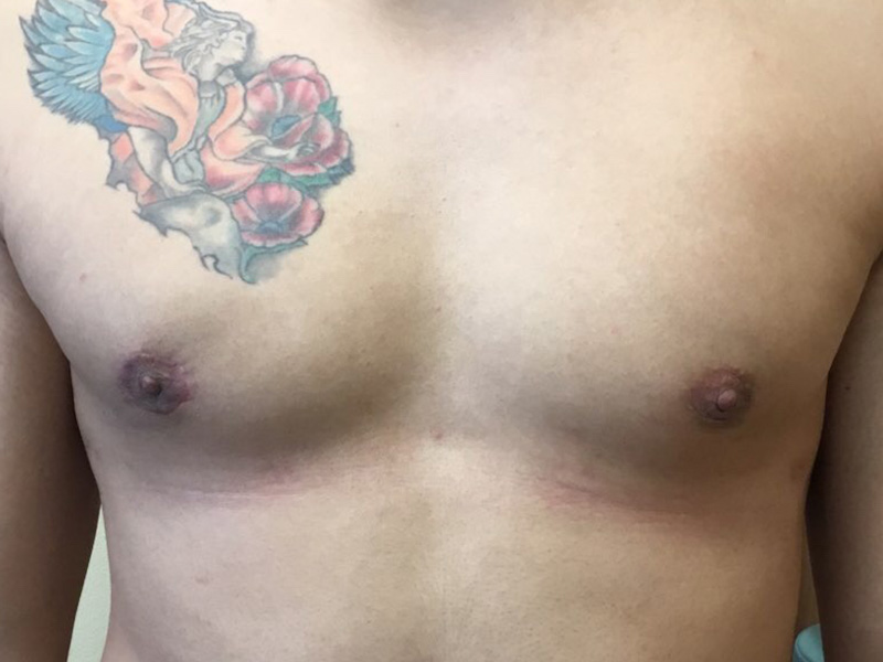 gynecomastia after