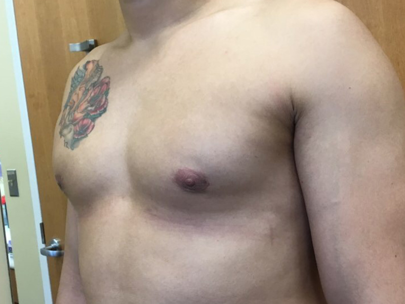 gynecomastia after 2