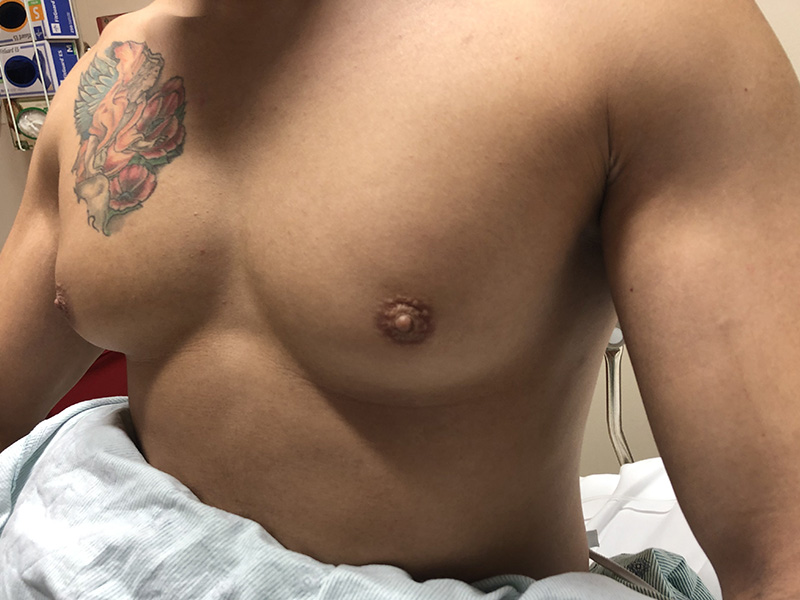 gynecomastia before 2
