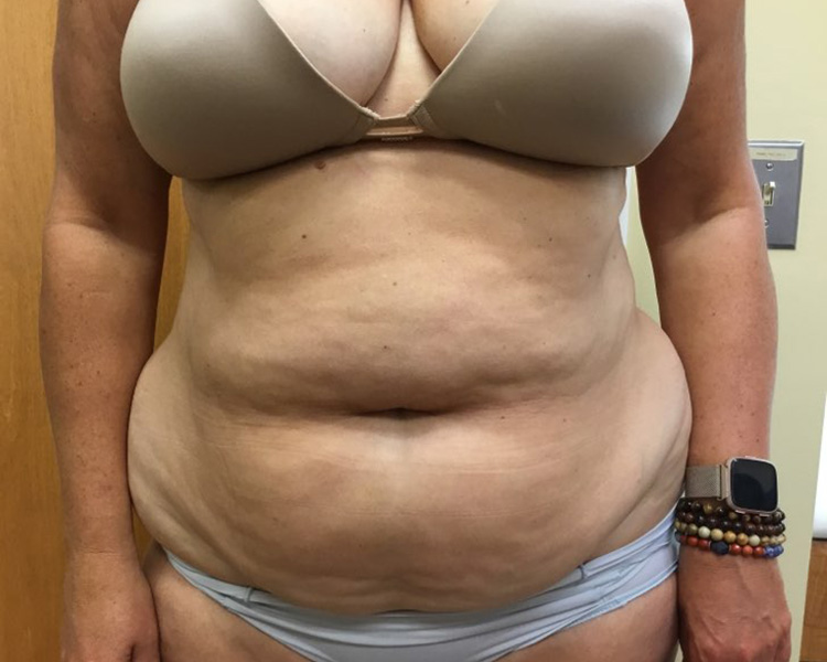 Before and After Tummy Tuck - Washington DC 1