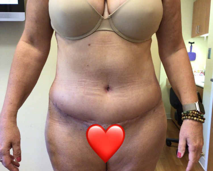 Before and After Tummy Tuck - Washington DC 2
