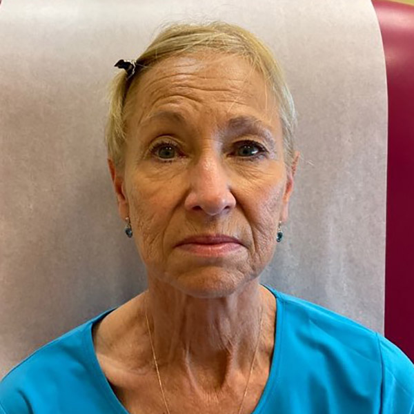 Before and After Lower Face and Neck Lift Washington DC 2